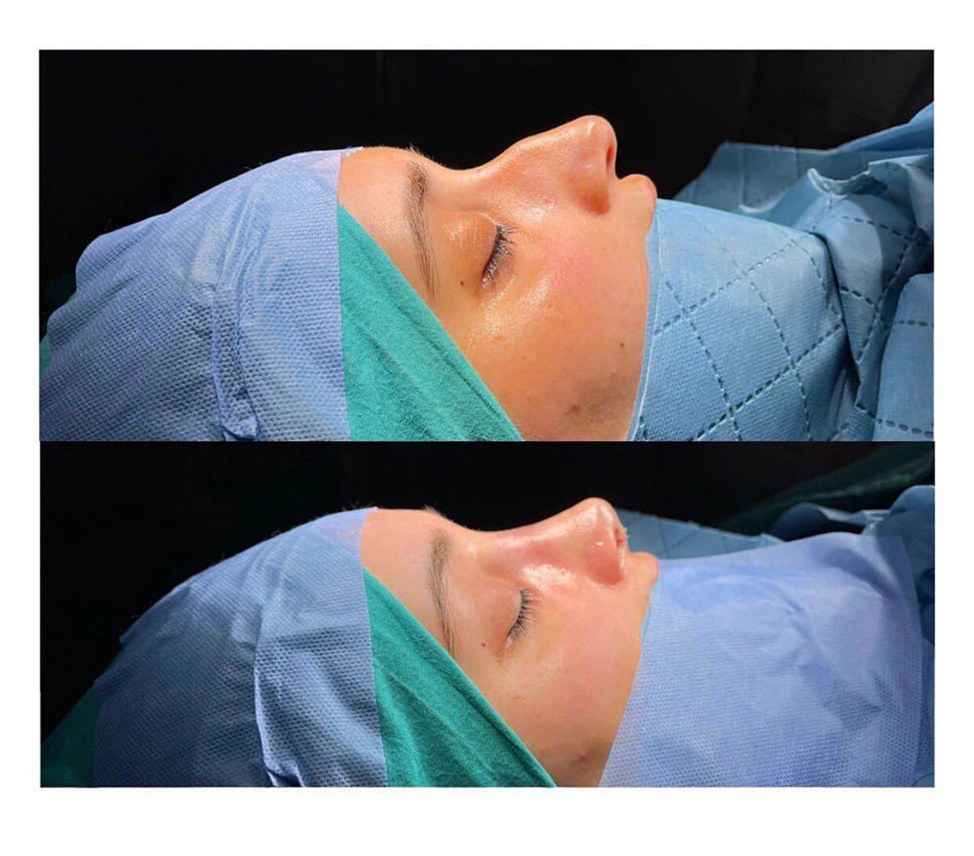 rhinoplasty